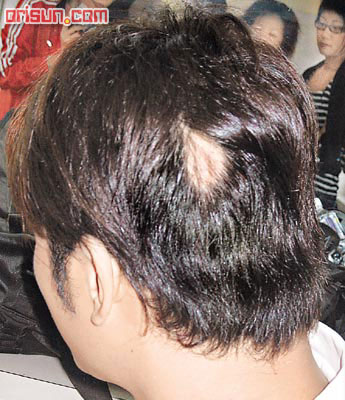 又出现俗称<em>鬼剃头</em>的<em>斑秃</em>