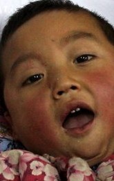 44 preschoolers hospitalized
