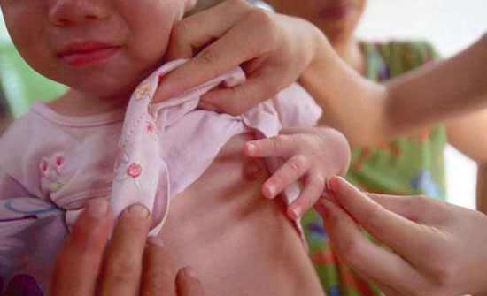 4岁女童下身见红来月经:乳房发育到拳头大小