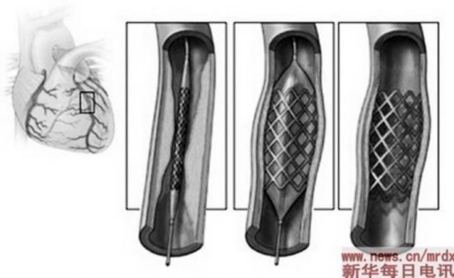 使用增长快是否滥用难界定 心脏支架背后的医