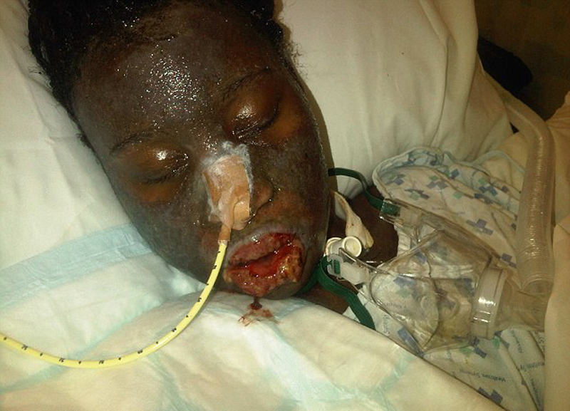 英国选美皇后眼药水过敏 面部皮肤脱落险丧命