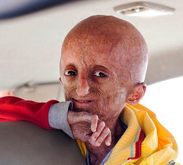 印度早衰男孩去世 身体衰老速度是常人8倍(组