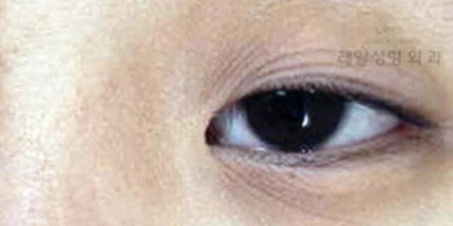 双眼皮贴的危害有哪些?