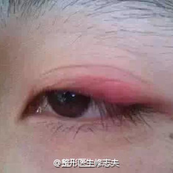 双眼皮贴的危害有哪些?