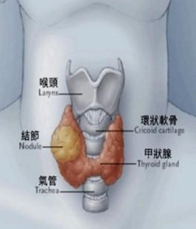 患上甲状腺结节 不必有“心结”90%以上的甲状腺结节都是良性