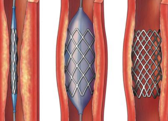 好消息！700元冠脉支架来了带量采购结果在甘肃省正式落地执行