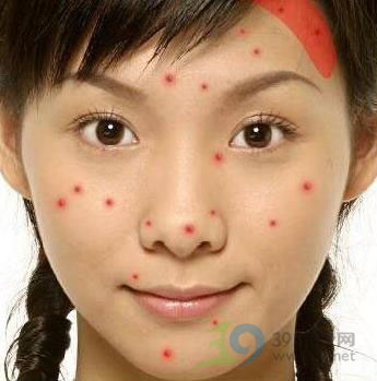 自测:从你长痘痘的位置看健康状况(组图)_中国