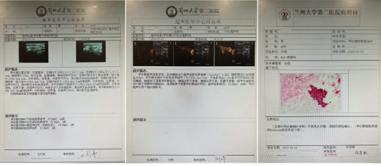 因"体检发现甲状腺结节(ti-rads 4a)",穿刺活检诊断为"甲状腺乳头状癌